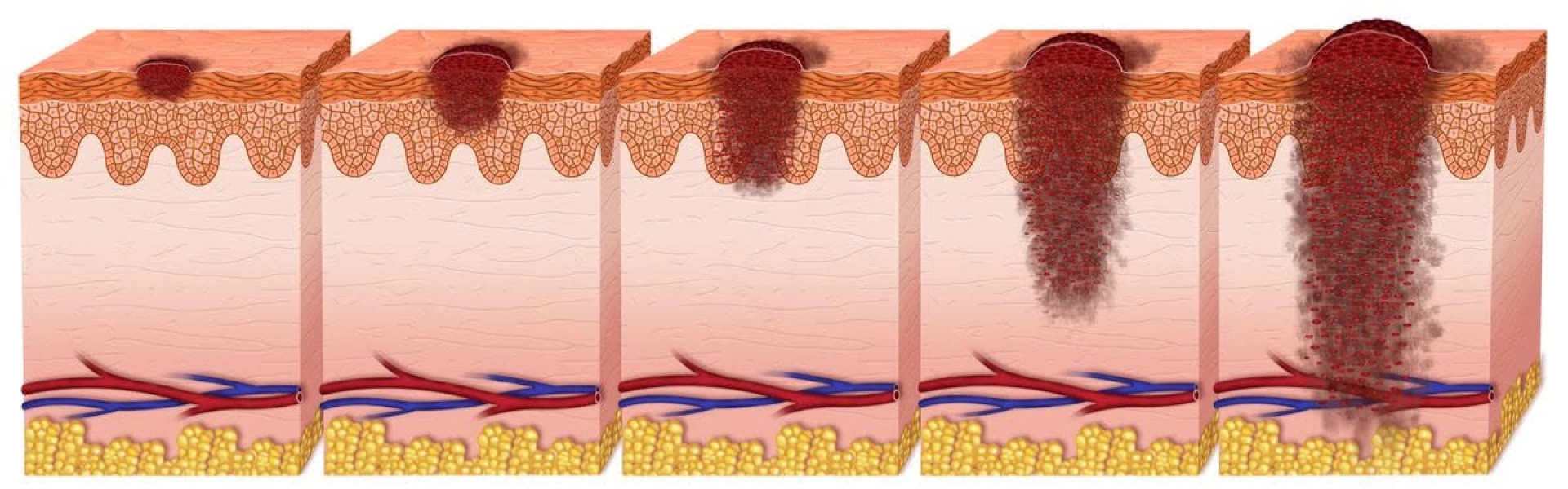 Gli stadi del melanoma